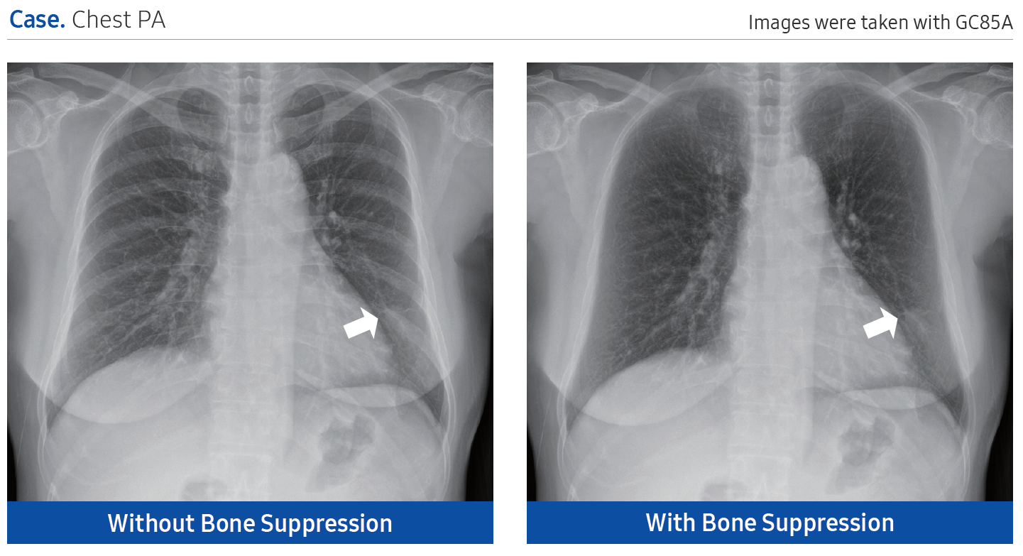 bone supression