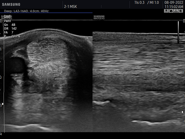 Superficial Digital Flexor Tendon