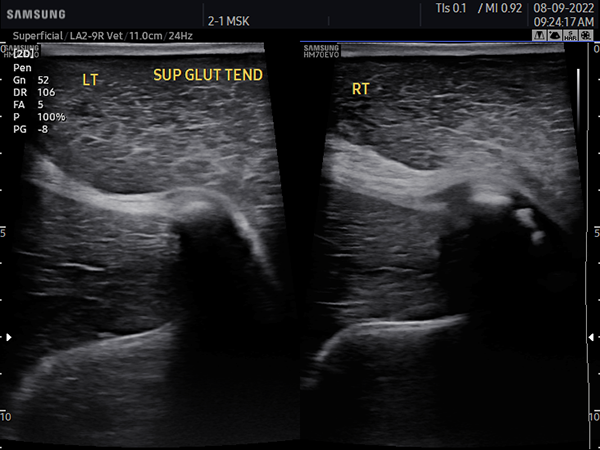 Sup glut tendon-1